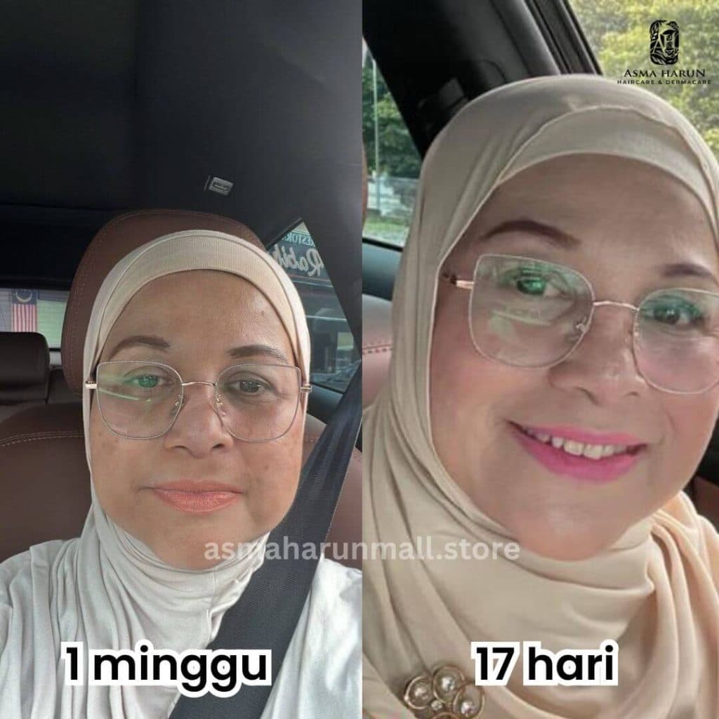 Testimonial before and after image showing reduced pigmentation on a woman's cheeks.