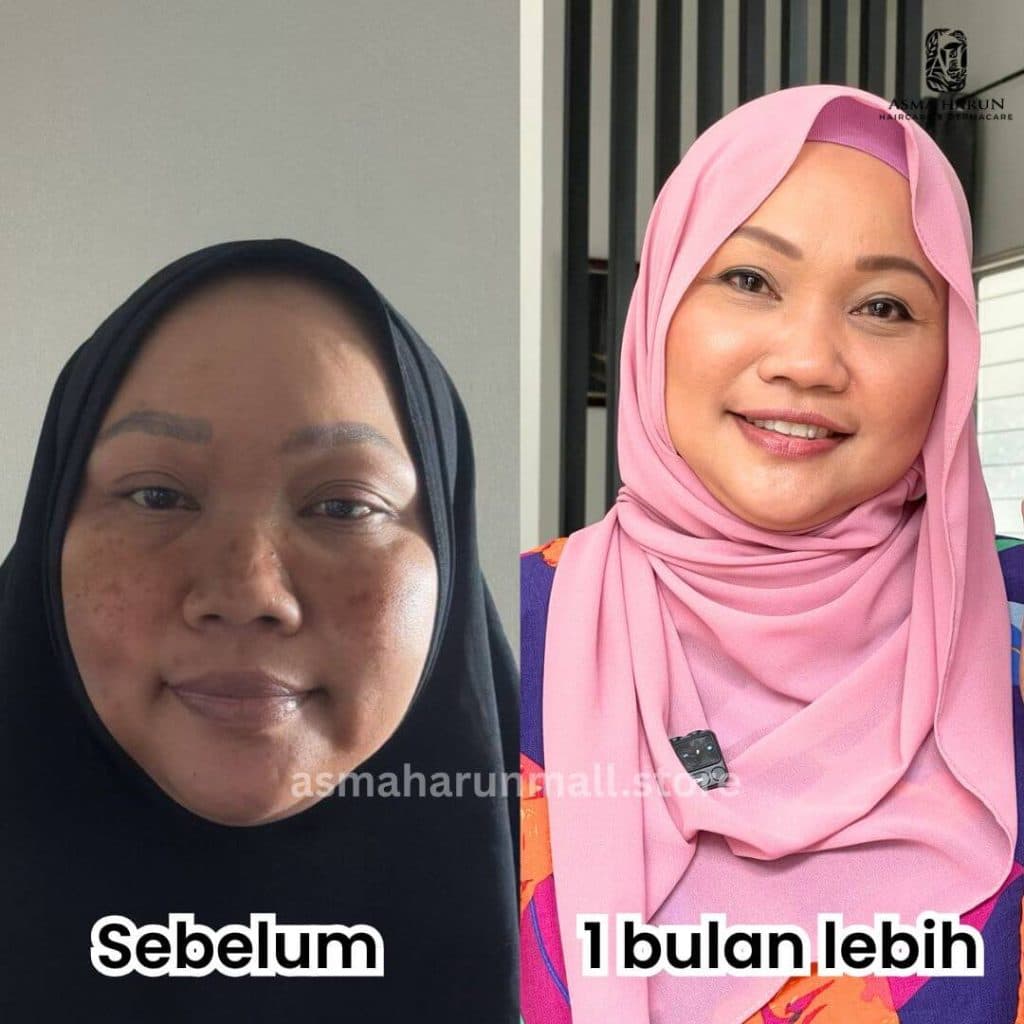 Testimonial before and after image showing faded spots on a woman's face.